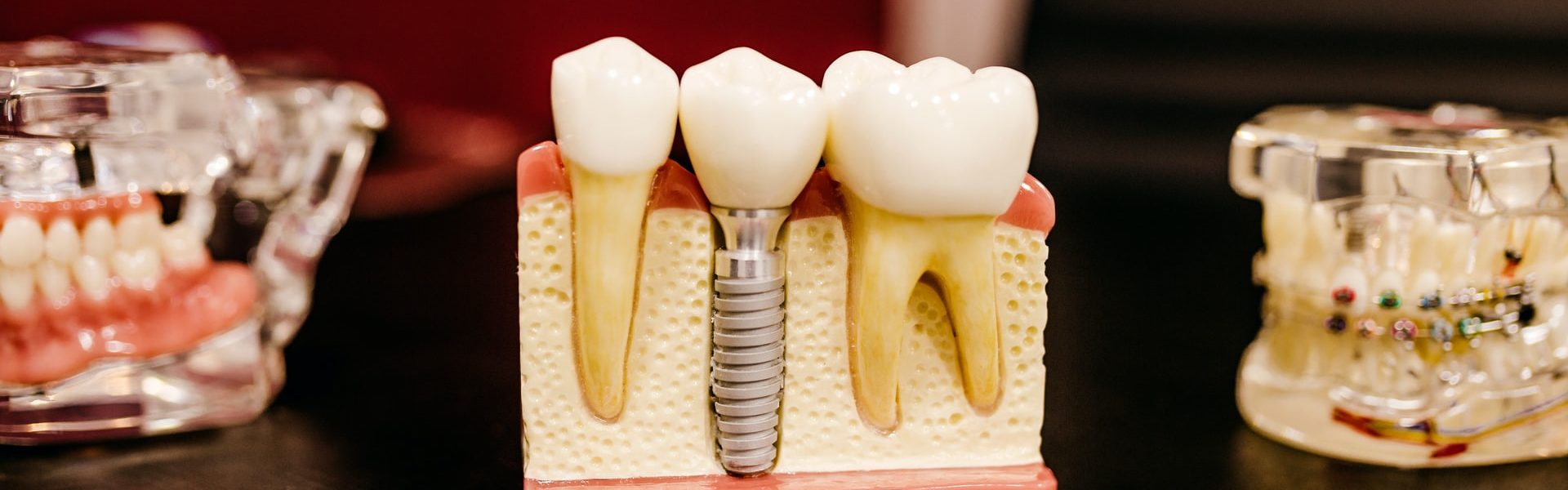 Why Root Canal Treatment Works and Shouldn’t Be Feared